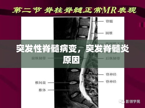 突發(fā)性脊髓病變，突發(fā)脊髓炎原因 