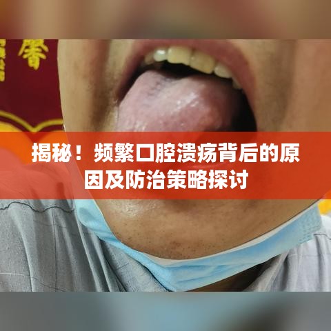 揭秘！頻繁口腔潰瘍背后的原因及防治策略探討