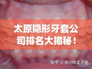 太原隱形牙套公司排名大揭秘！專業(yè)矯正牙齒，打造自信笑容！